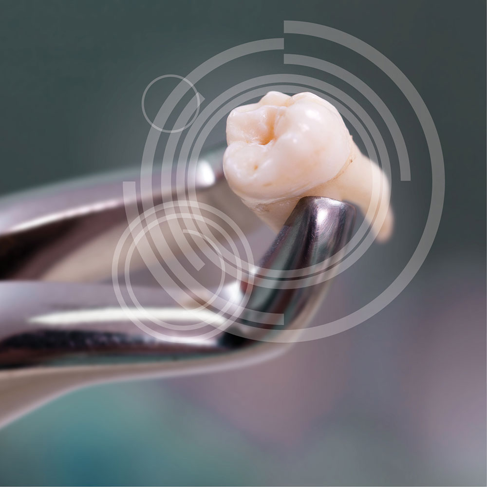 Weisheitszahnentfernung - MKG-Chirurgie Erfurt Weisheitszahnentfernung - MKG-Chirurgie Erfurt
