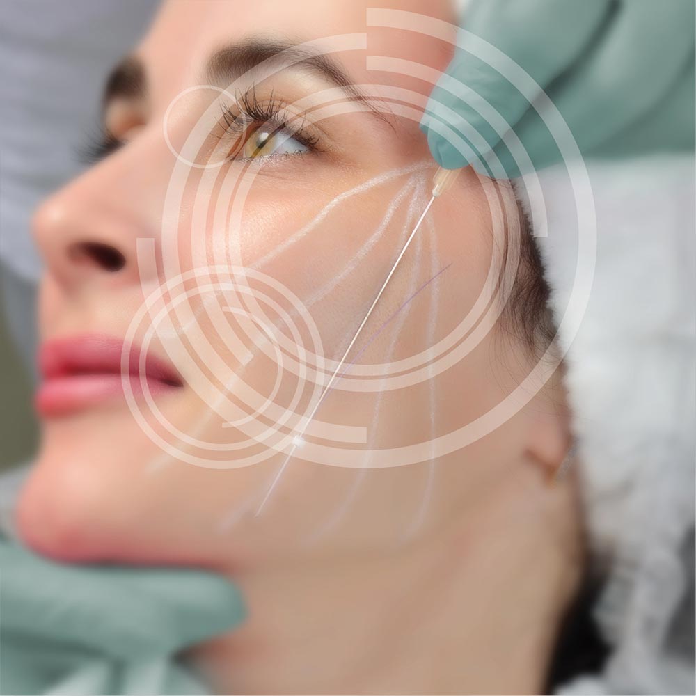 Fadenlifting - MKG-Chirurgie Erfurt Fadenlifting - MKG-Chirurgie Erfurt