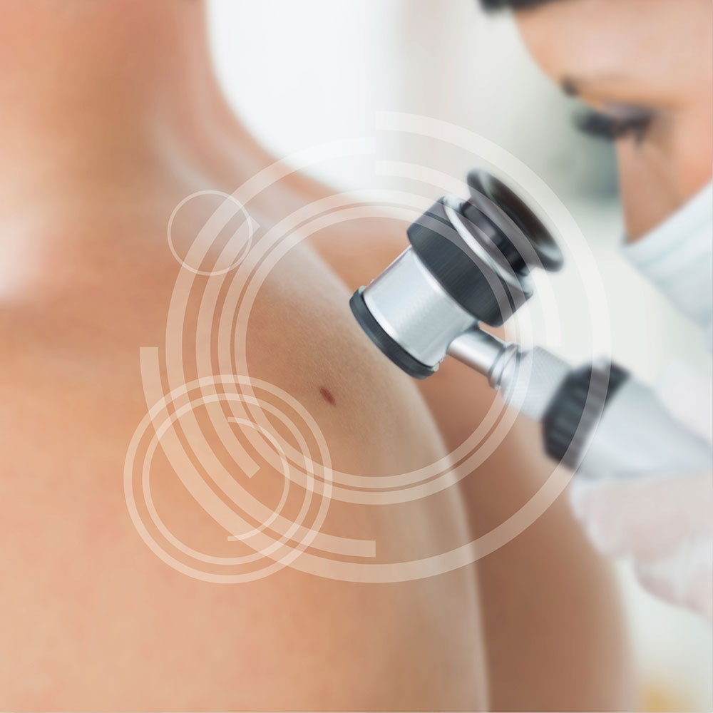 Entfernung von Hautveränderungen jeglicher Art - MKG-Chirurgie Erfurt Entfernung von Hautveränderungen jeglicher Art - MKG-Chirurgie Erfurt