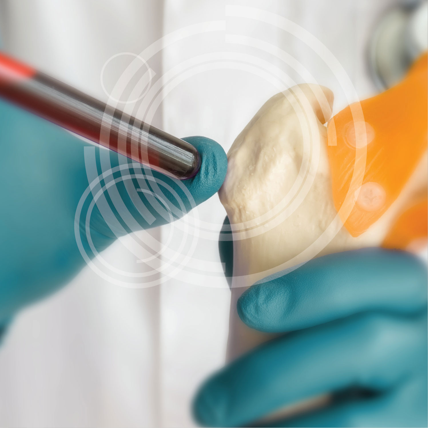 Knochenaufbau mittels Eigenblut (PRF) - MKG-Chirurgie Erfurt Knochenaufbau mittels Eigenblut (PRF) - MKG-Chirurgie Erfurt