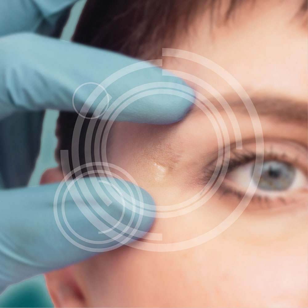 sma-narbenkorrekturen-3 Entfernung von Hautveränderungen jeglicher Art - MKG-Chirurgie Erfurt